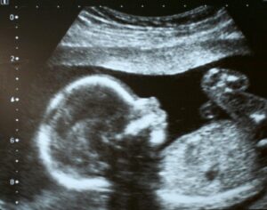 Ultrasound of baby in utero
